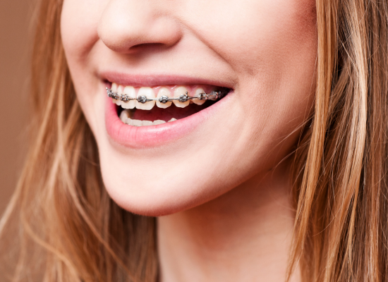 braces in brampton