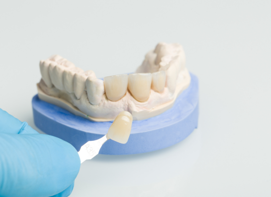 dental-crowns-in-brampton